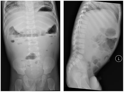 Two Novel Mutations in the SI Gene Associated With Congenital Sucrase-Isomaltase Deficiency: A Case Report in China